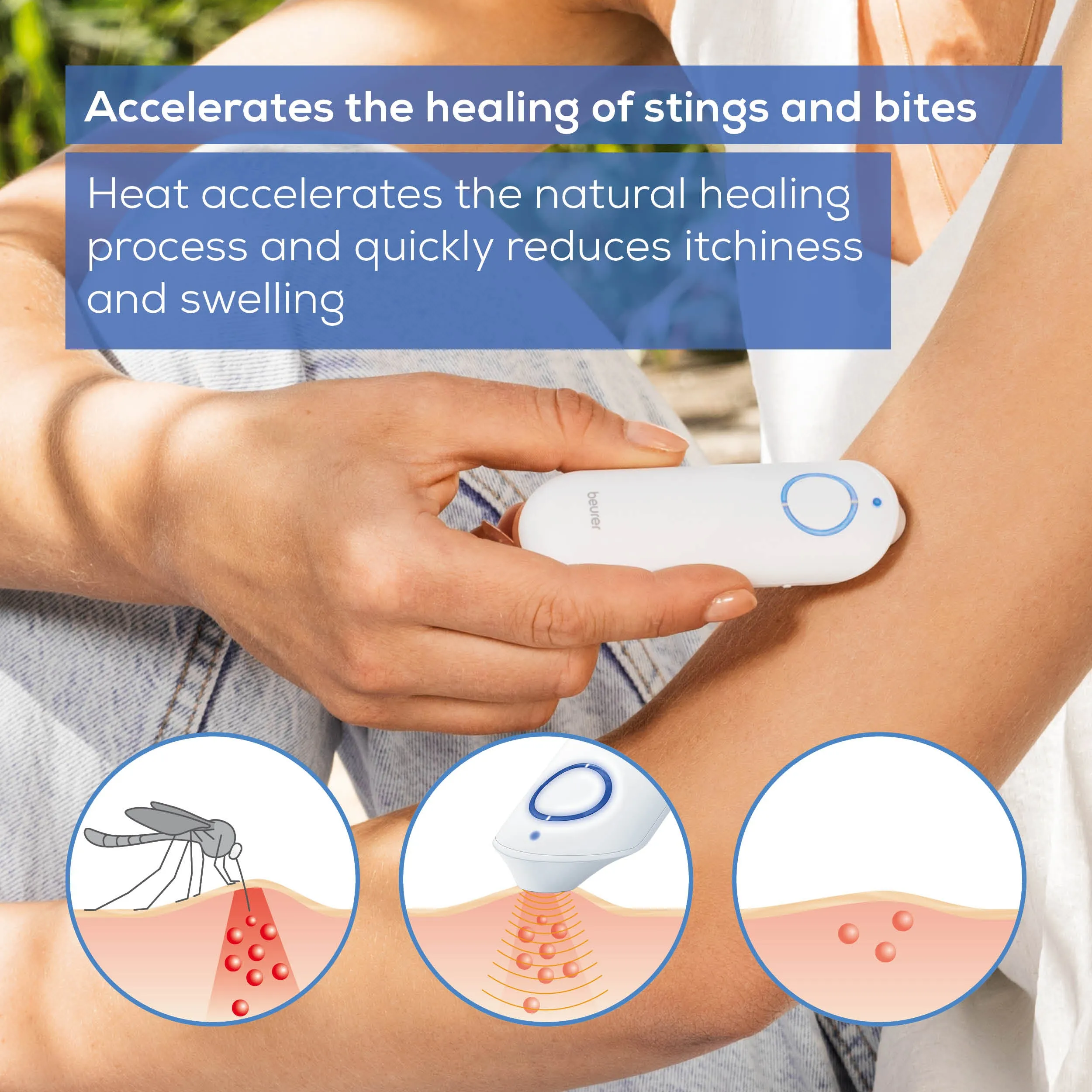 Beurer Insect Bite Healer White Battery Removes All Insect Bites Within 3-6 Seconds For Al